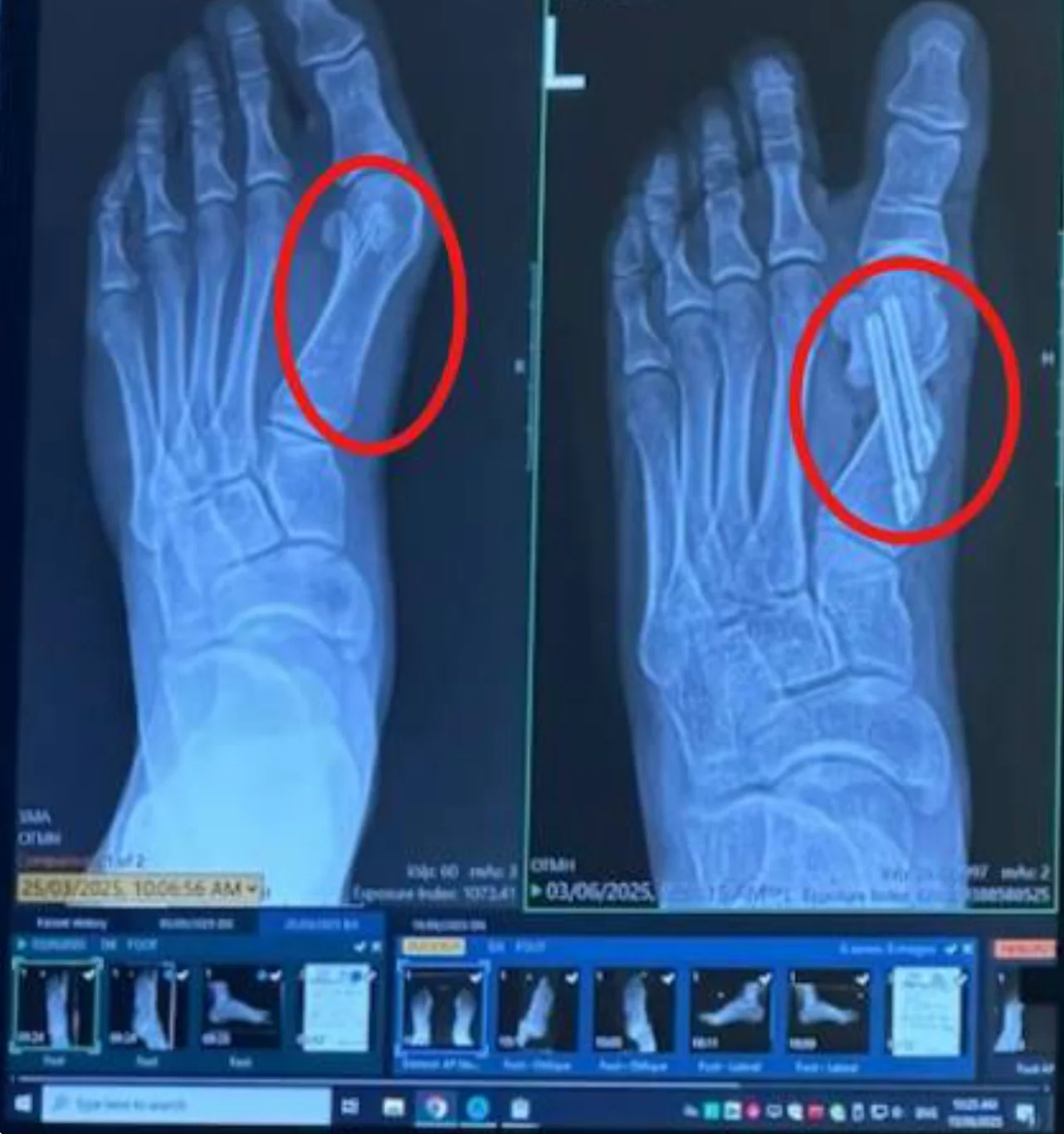 X-ray of bunion surgery with screws