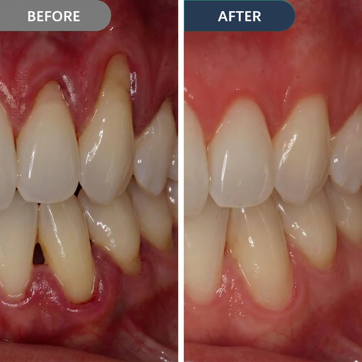 Precision Gum Care Gel – Daily Support for Sensitive, Tender & Bleeding Gums.