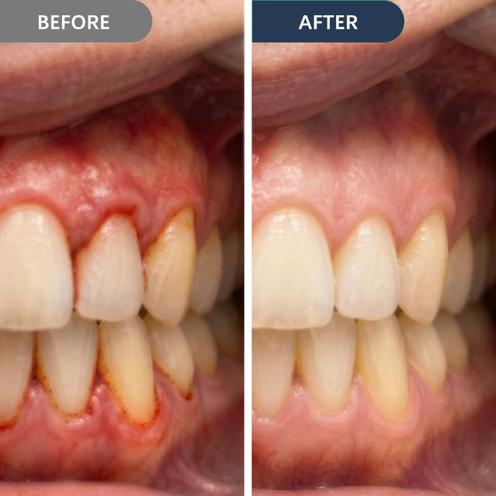 Precision Gum Care Gel – Daily Support for Sensitive, Tender & Bleeding Gums.